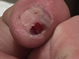 Rheumatoid Vasculitis