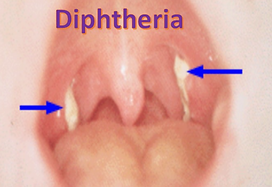 White patches on throat (Diptheria)